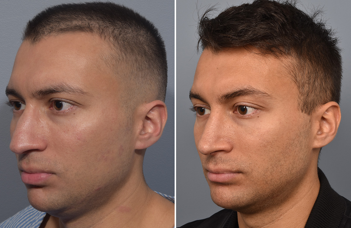 Rhinoplasty Before & After Gallery - Patient 341429 - Image 5