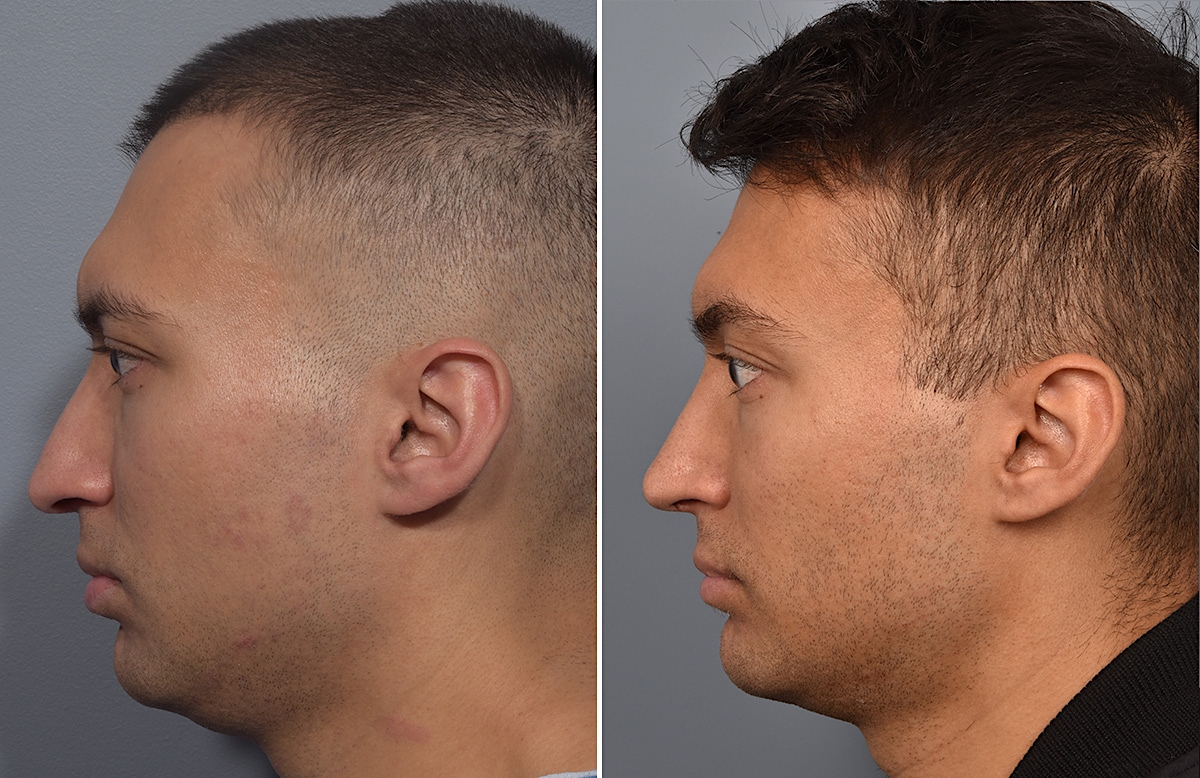Rhinoplasty Before & After Gallery - Patient 341429 - Image 6