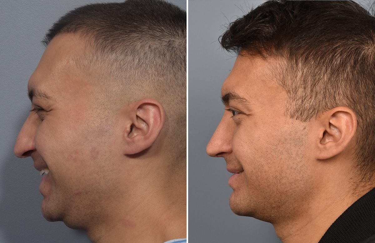 Rhinoplasty Before & After Gallery - Patient 341429 - Image 7