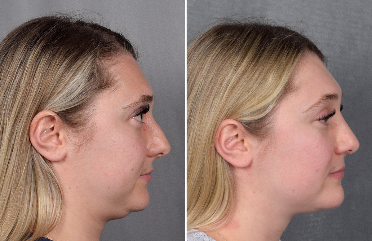 Rhinoplasty Before & After Gallery - Patient 209088 - Image 2