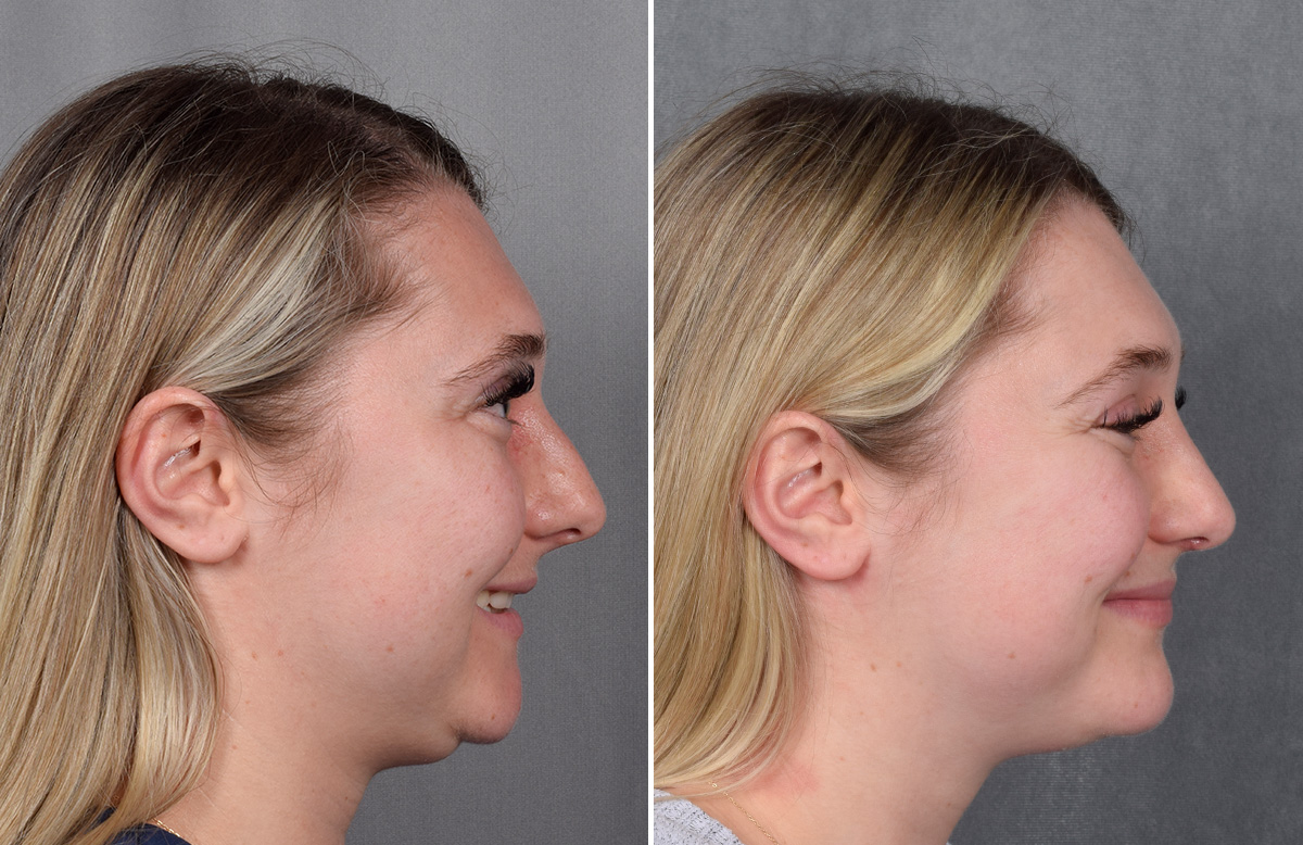 Rhinoplasty Before & After Gallery - Patient 209088 - Image 1
