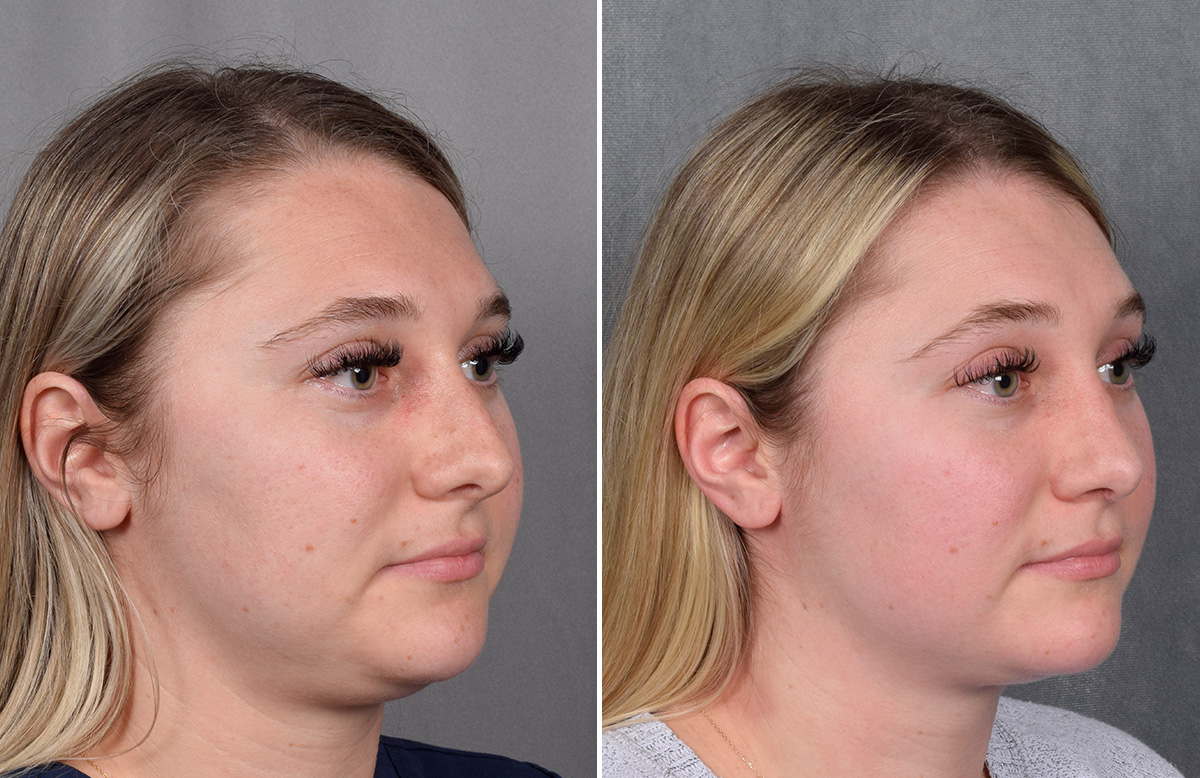 Rhinoplasty Before & After Gallery - Patient 209088 - Image 3