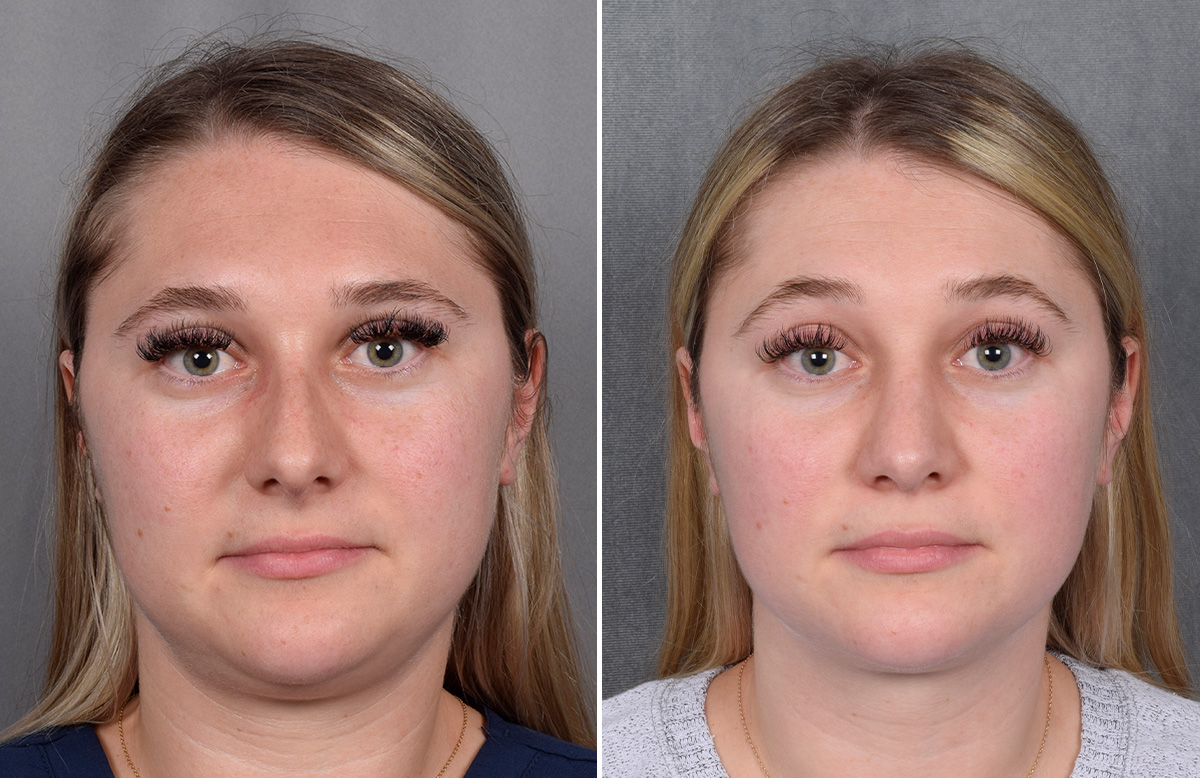 Rhinoplasty Before & After Gallery - Patient 209088 - Image 4