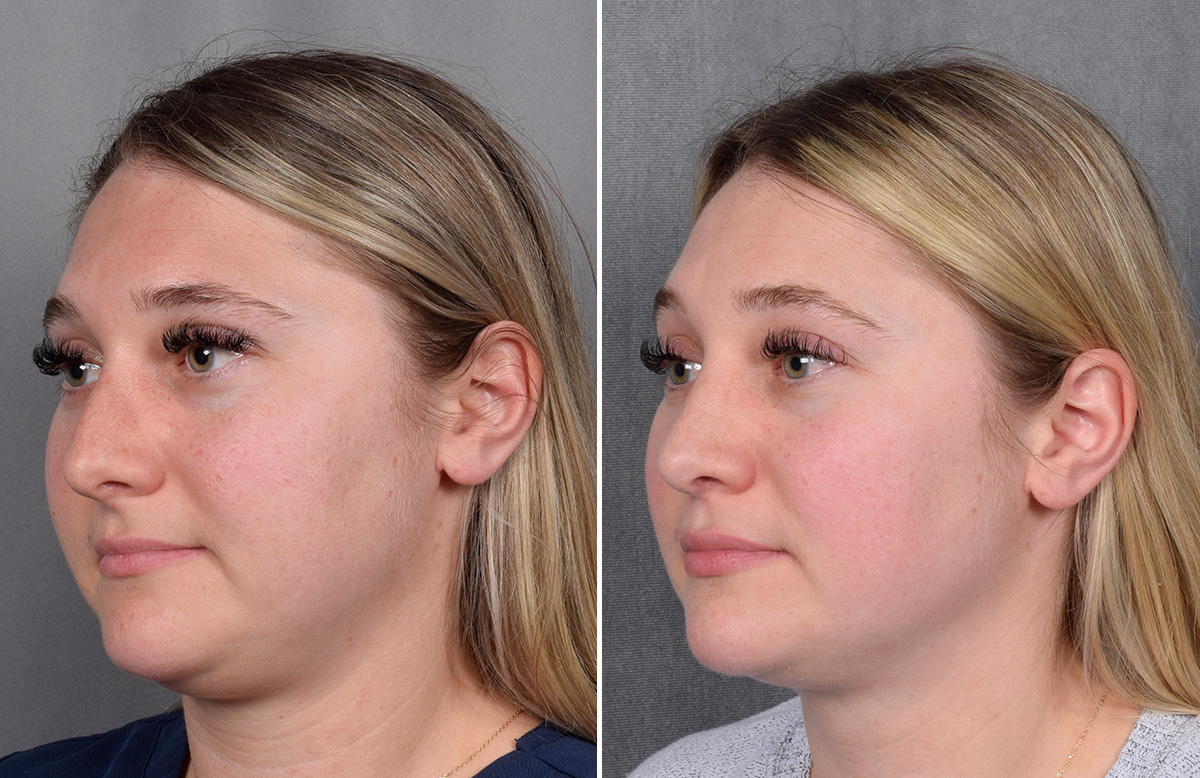 Rhinoplasty Before & After Gallery - Patient 209088 - Image 5