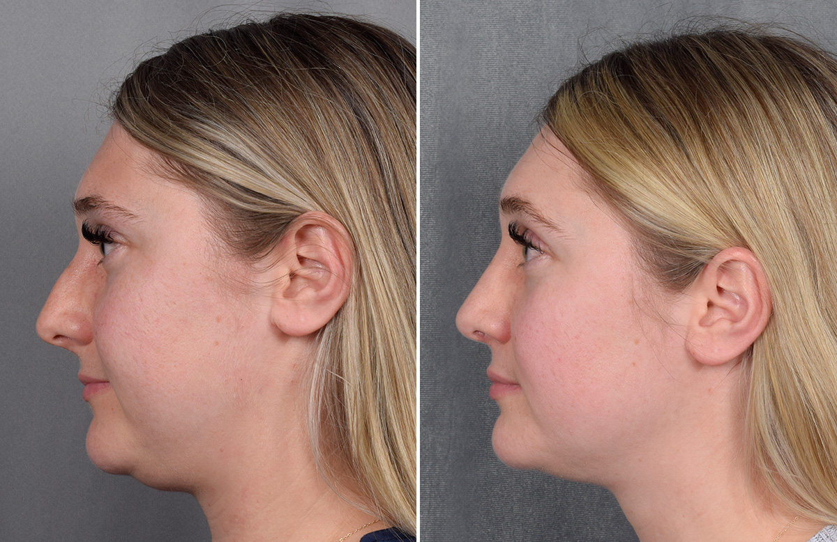 Rhinoplasty Before & After Gallery - Patient 209088 - Image 6