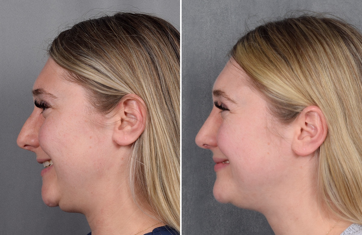 Rhinoplasty Before & After Gallery - Patient 209088 - Image 7