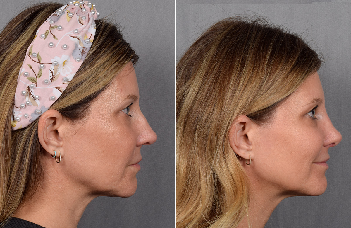 Rhinoplasty Before & After Gallery - Patient 215384 - Image 2
