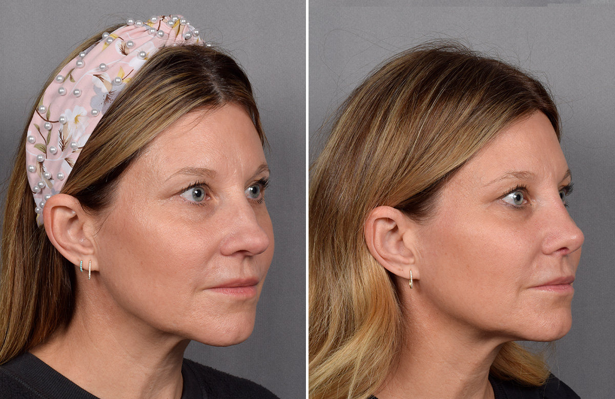 Rhinoplasty Before & After Gallery - Patient 215384 - Image 3