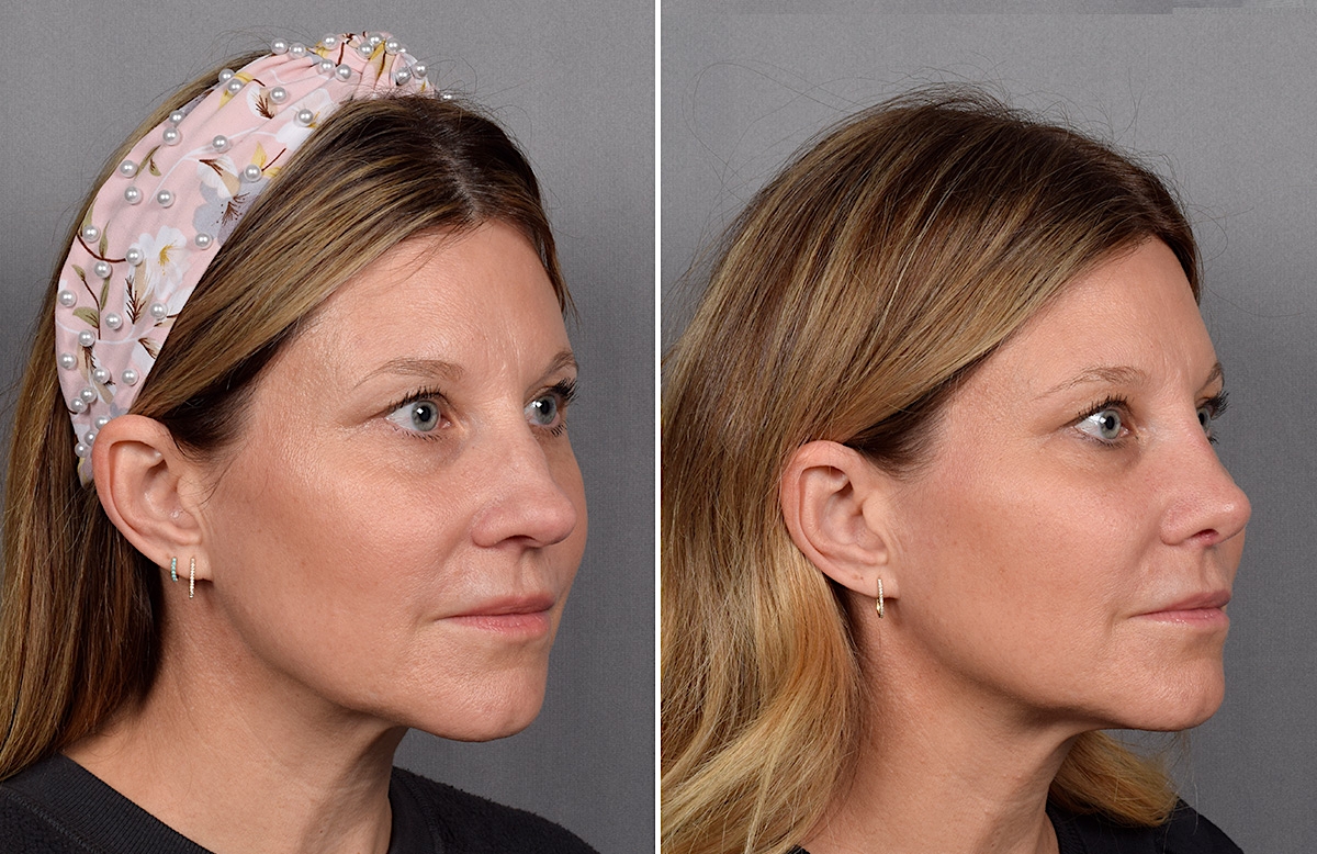 Rhinoplasty Before & After Gallery - Patient 215384 - Image 3