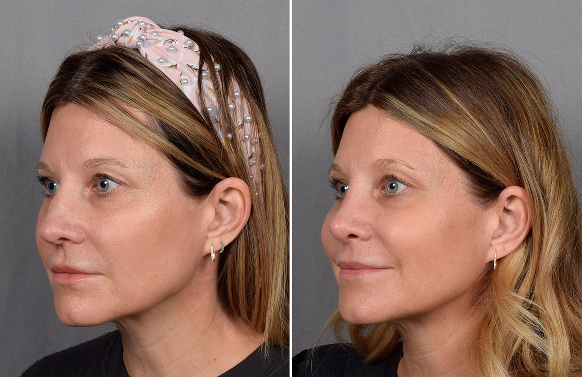 Rhinoplasty Before & After Gallery - Patient 215384 - Image 5