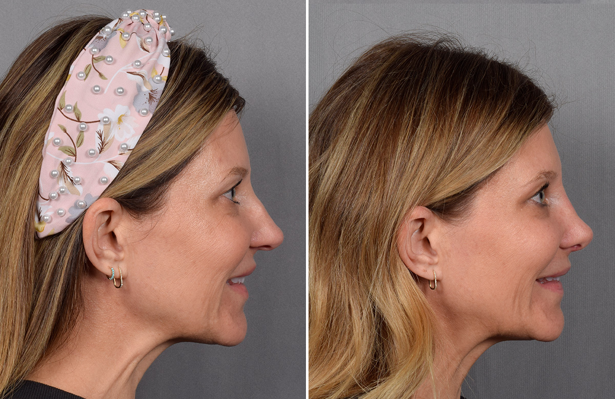 Rhinoplasty Before & After Gallery - Patient 215384 - Image 1