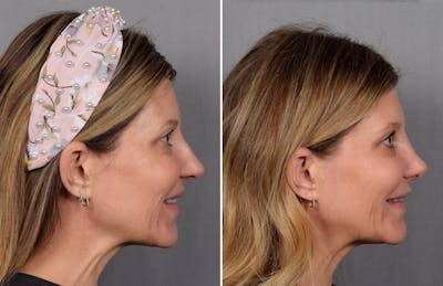 Rhinoplasty Before & After Gallery - Patient 215384 - Image 1