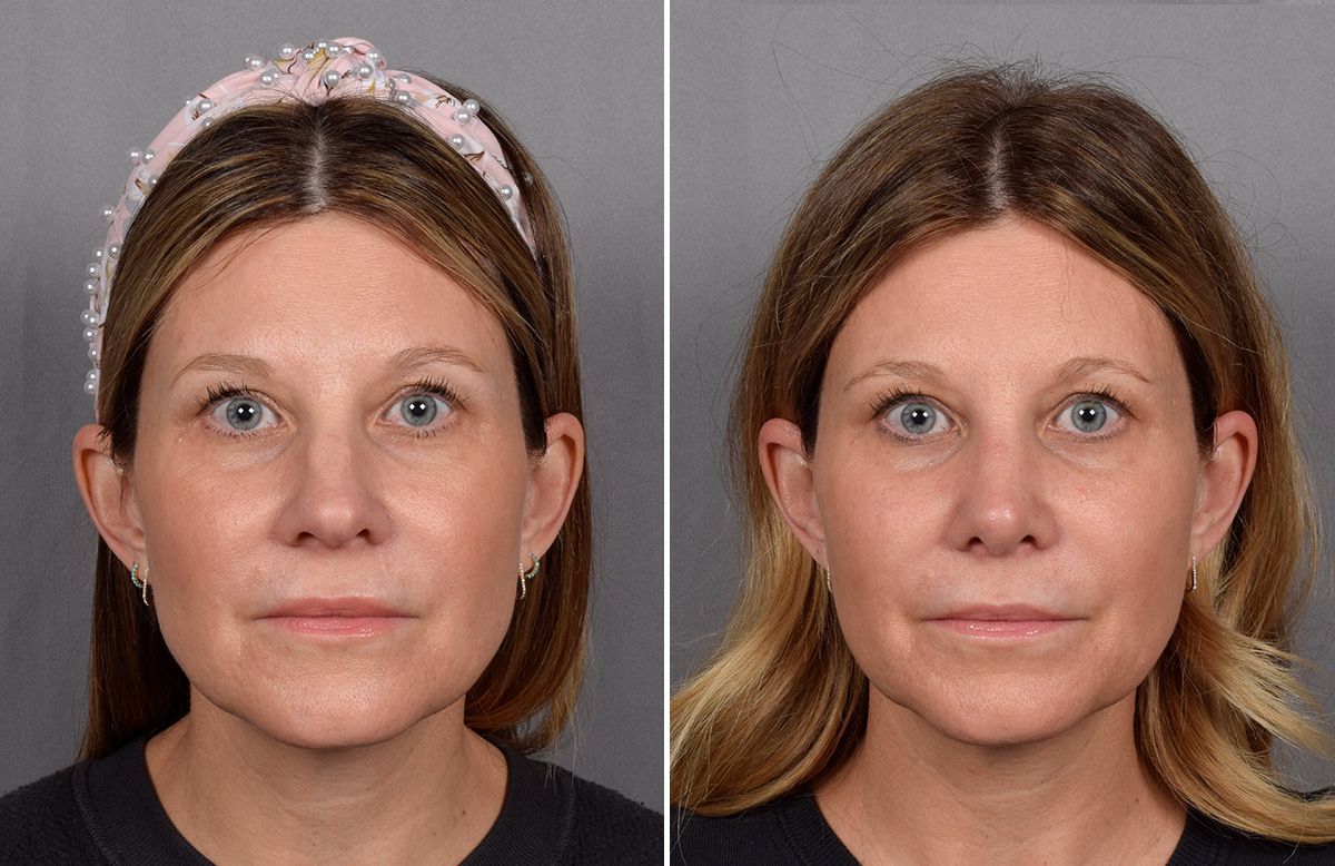 Rhinoplasty Before & After Gallery - Patient 215384 - Image 4