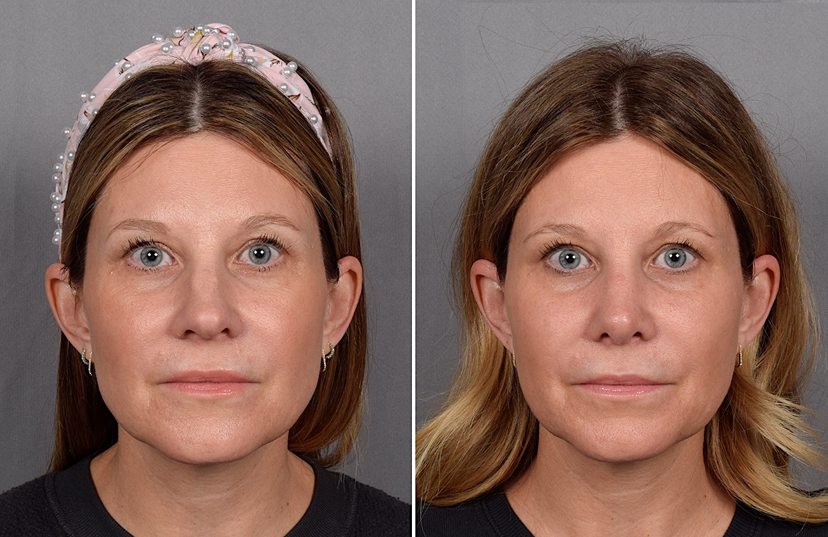 Rhinoplasty Before & After Gallery - Patient 215384 - Image 4