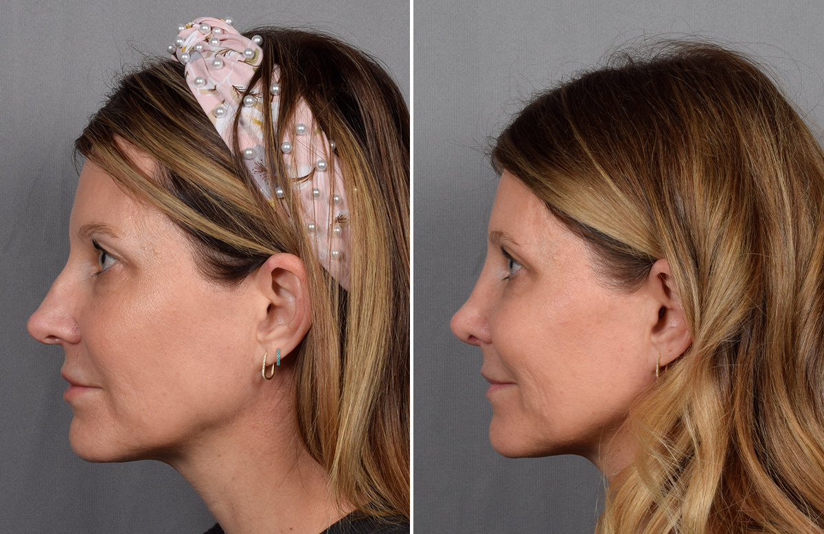 Rhinoplasty Before & After Gallery - Patient 215384 - Image 6