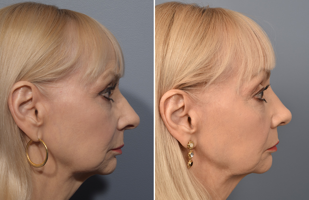 Rhinoplasty Before & After Gallery - Patient 140831 - Image 1