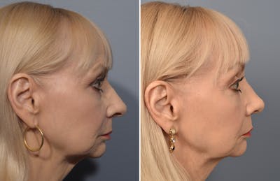Rhinoplasty Before & After Gallery - Patient 140831 - Image 1