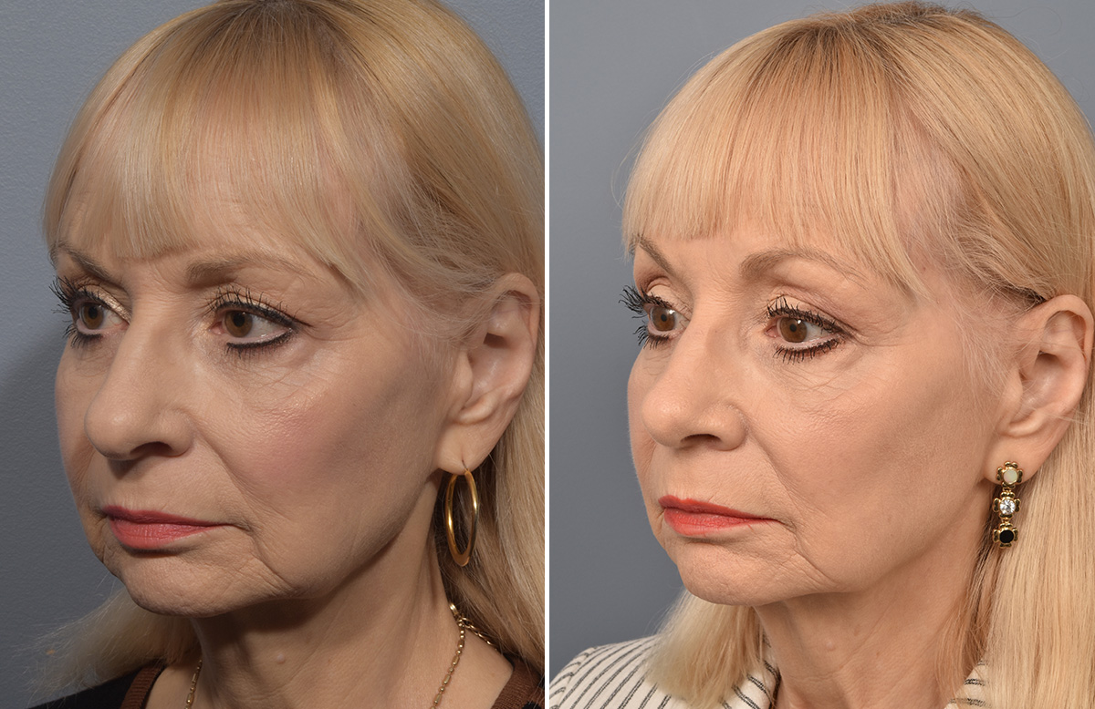 Rhinoplasty Before & After Gallery - Patient 140831 - Image 4