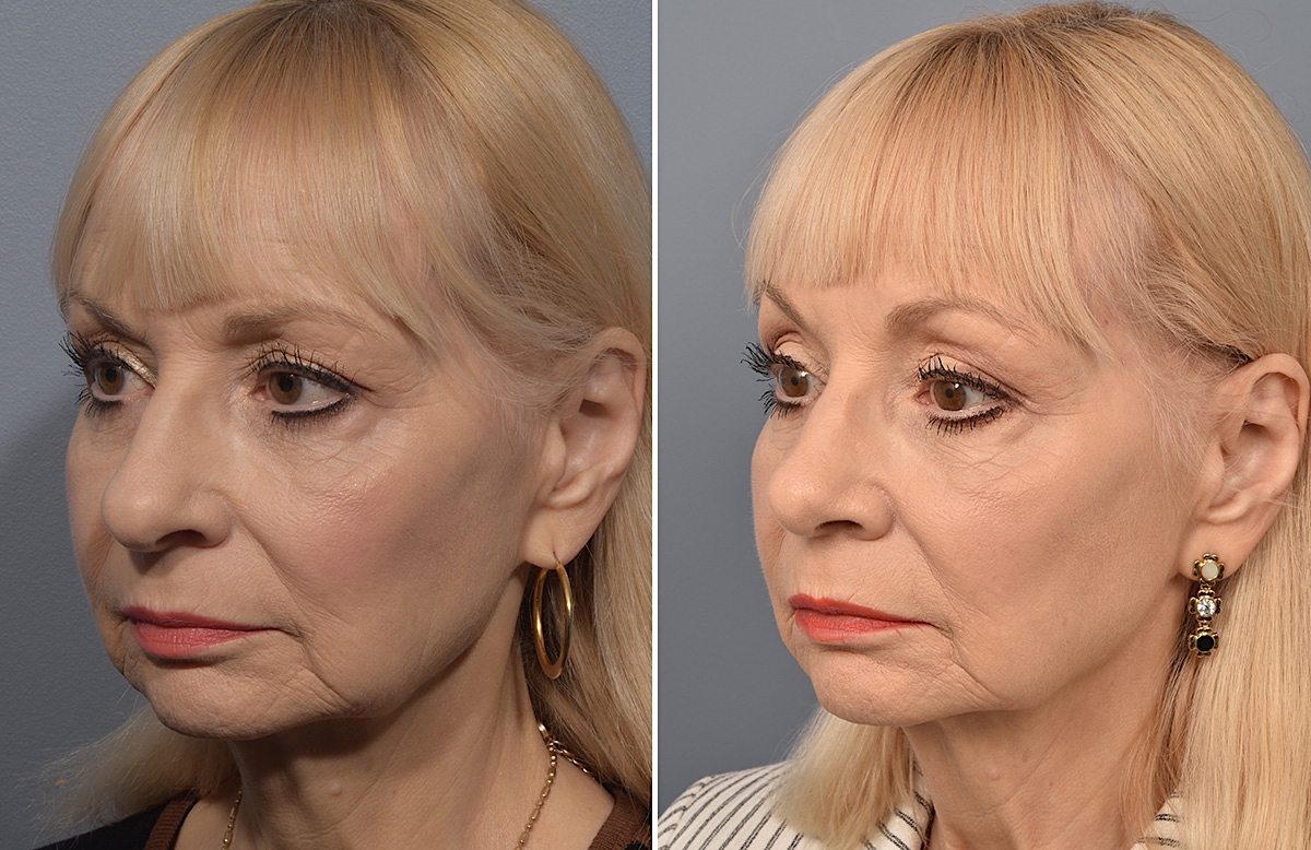 Rhinoplasty Before & After Gallery - Patient 140831 - Image 4