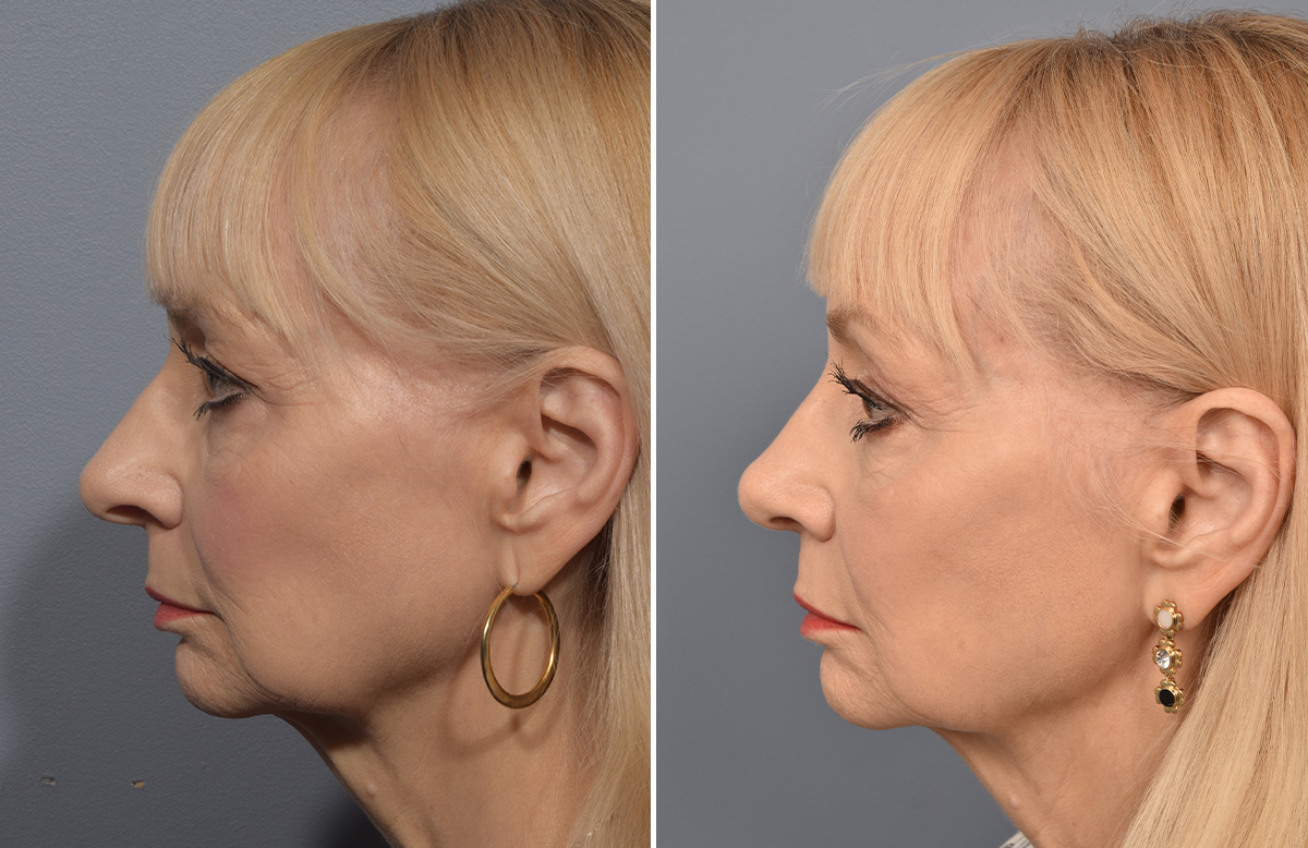 Rhinoplasty Before & After Gallery - Patient 140831 - Image 5