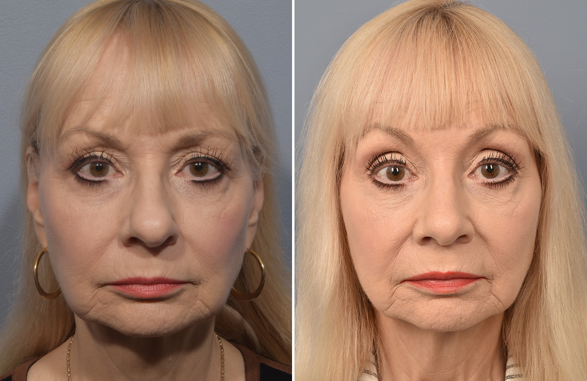 Rhinoplasty Before & After Gallery - Patient 140831 - Image 3