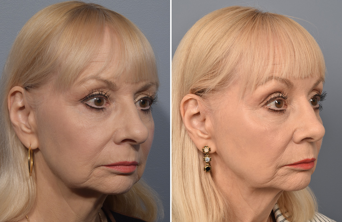 Rhinoplasty Before & After Gallery - Patient 140831 - Image 2