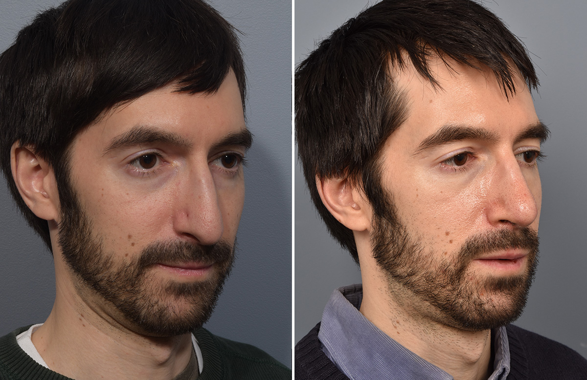 Rhinoplasty Before & After Gallery - Patient 338770 - Image 3