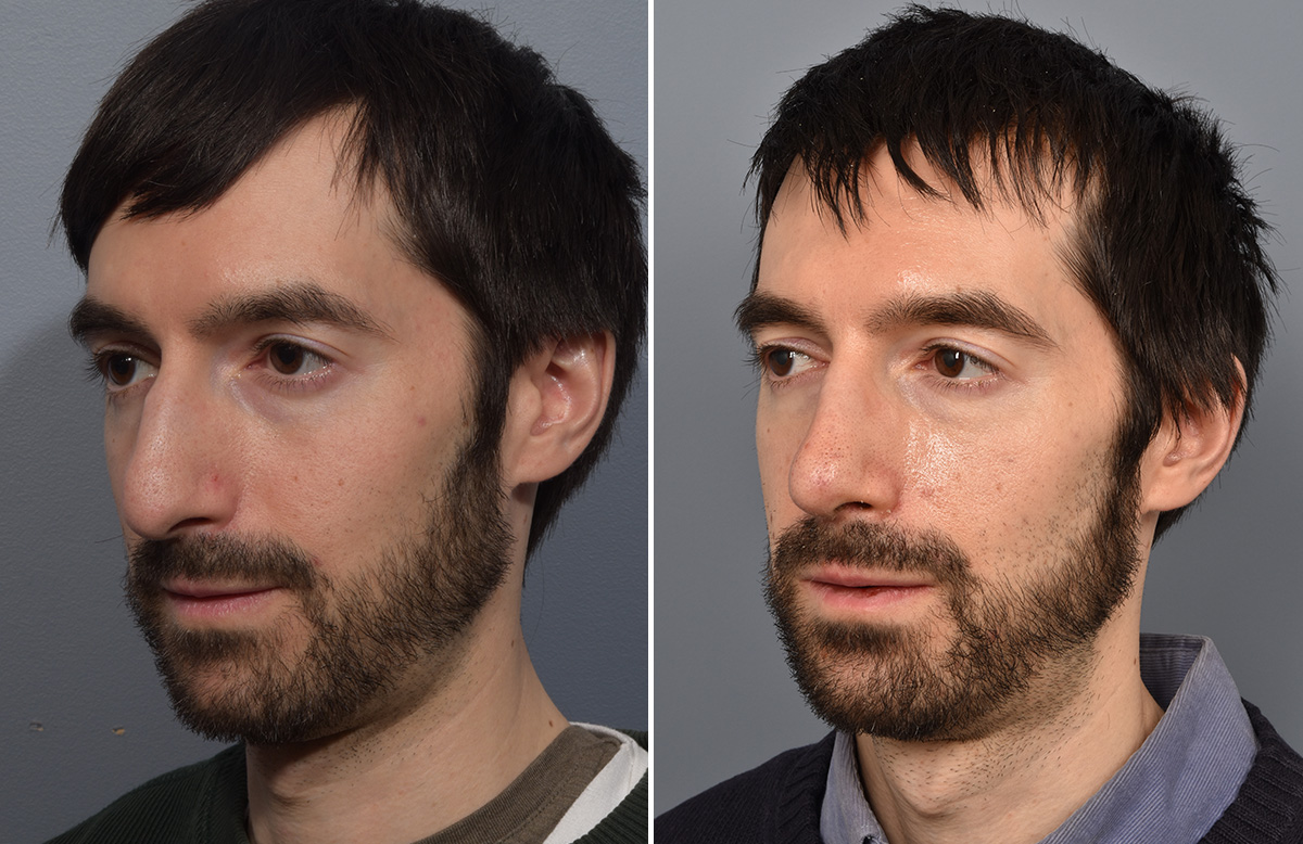 Rhinoplasty Before & After Gallery - Patient 338770 - Image 5