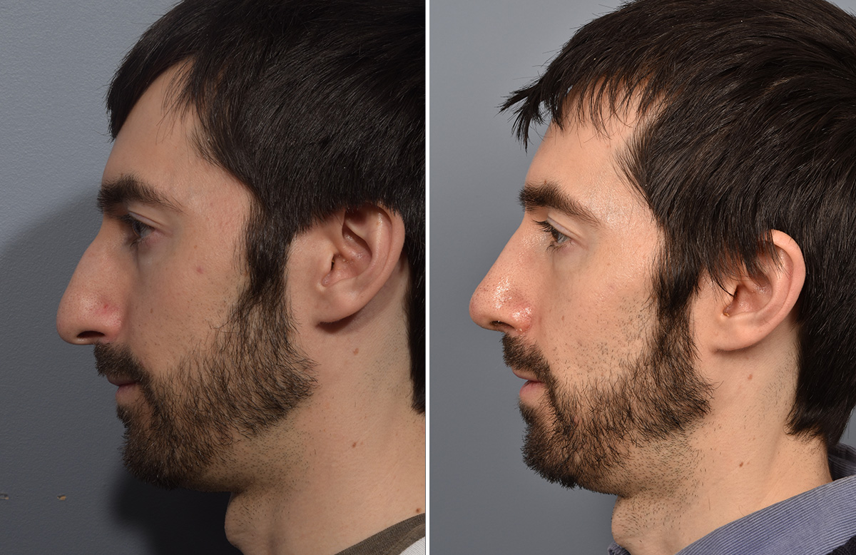 Rhinoplasty Before & After Gallery - Patient 338770 - Image 6