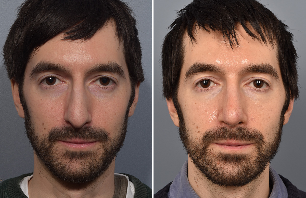 Rhinoplasty Before & After Gallery - Patient 338770 - Image 4