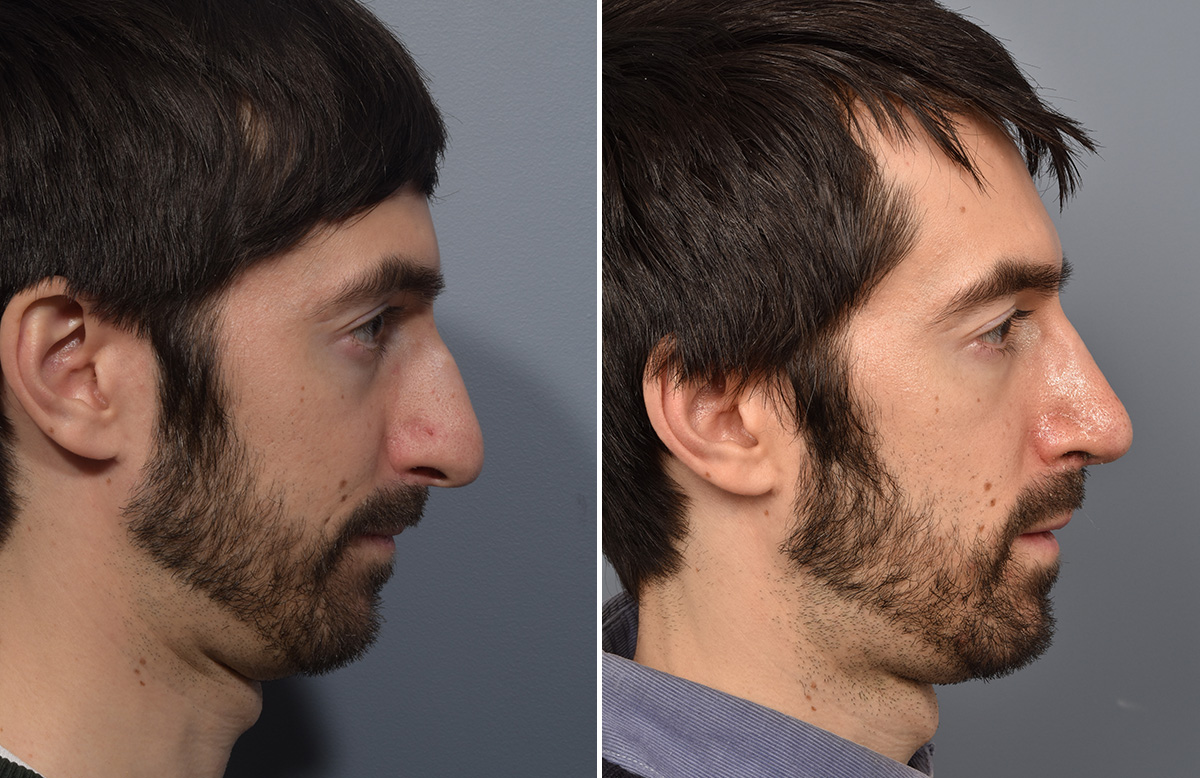 Rhinoplasty Before & After Gallery - Patient 338770 - Image 2