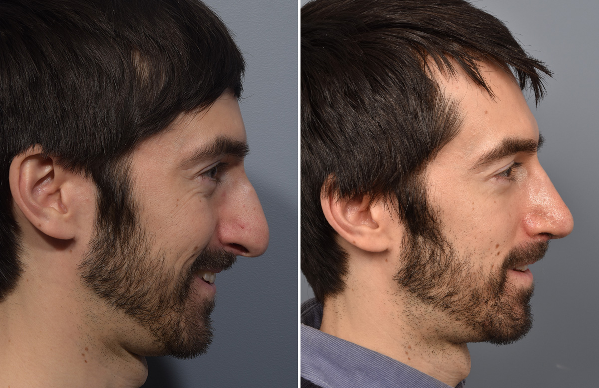 Rhinoplasty Before & After Gallery - Patient 338770 - Image 1