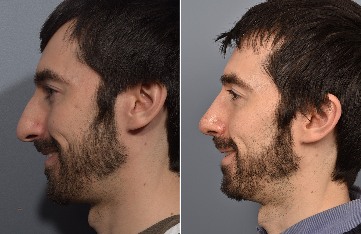 Rhinoplasty Before & After Gallery - Patient 338770 - Image 7