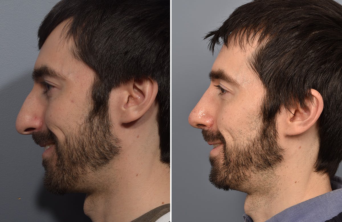 Rhinoplasty Before & After Gallery - Patient 338770 - Image 7