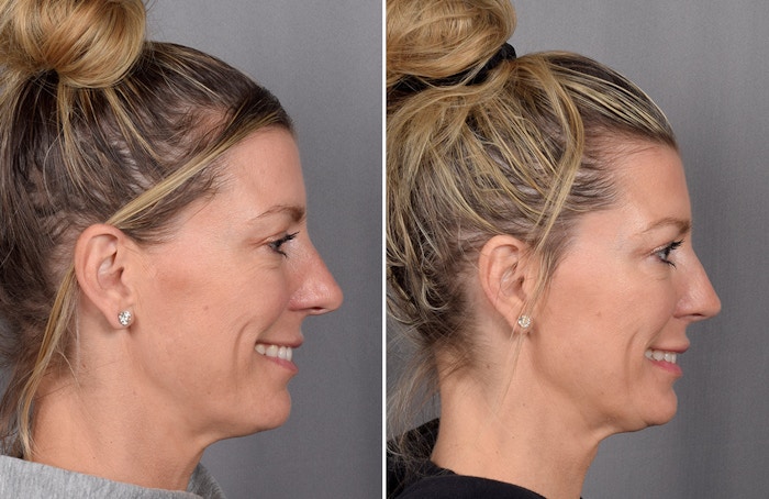 Rhinoplasty Before & After Gallery - Patient 622561 - Image 1