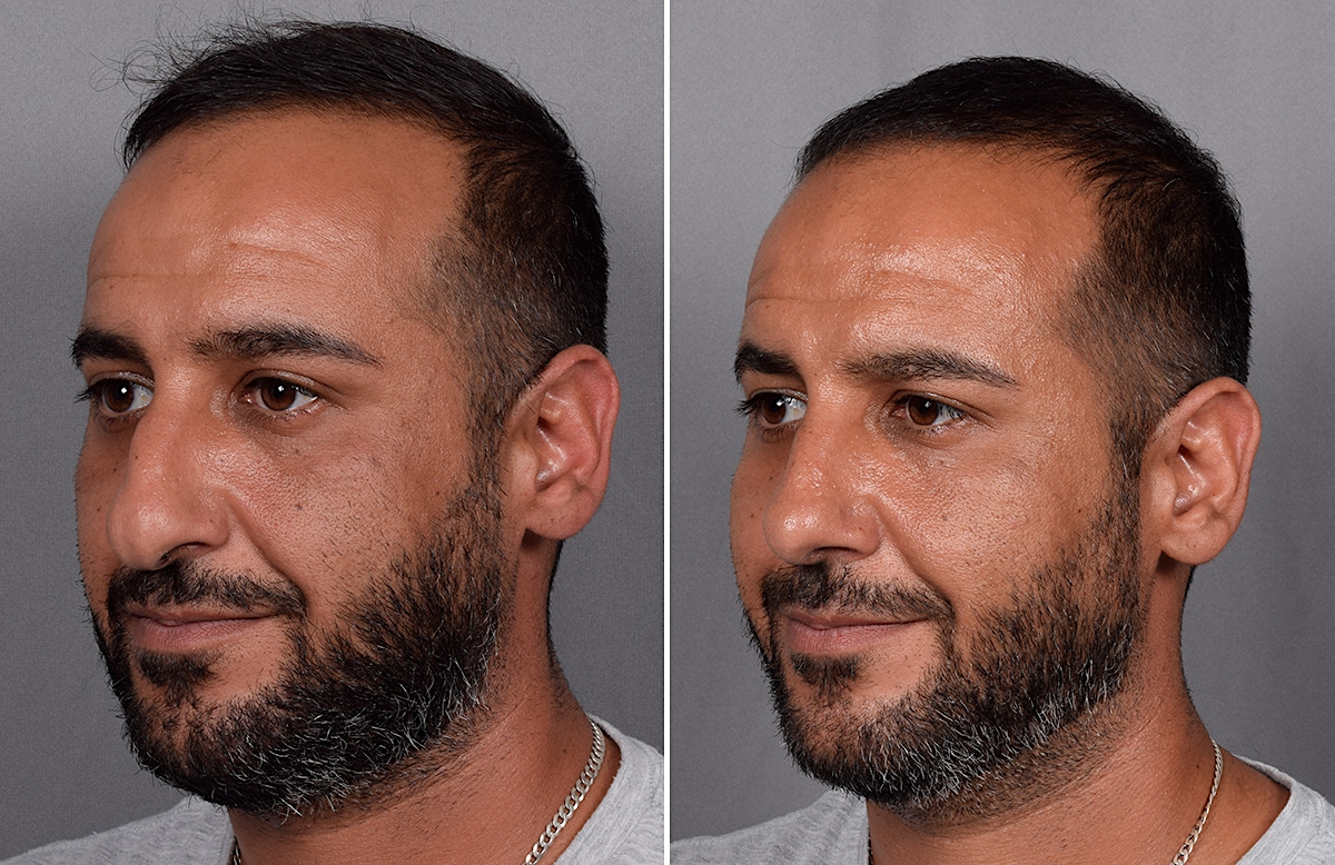 Rhinoplasty Before & After Gallery - Patient 253649 - Image 5