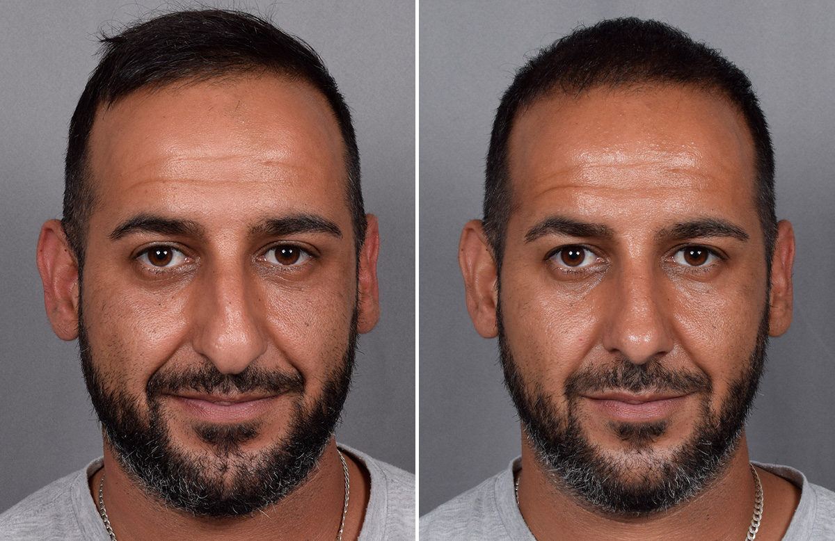 Rhinoplasty Before & After Gallery - Patient 253649 - Image 4