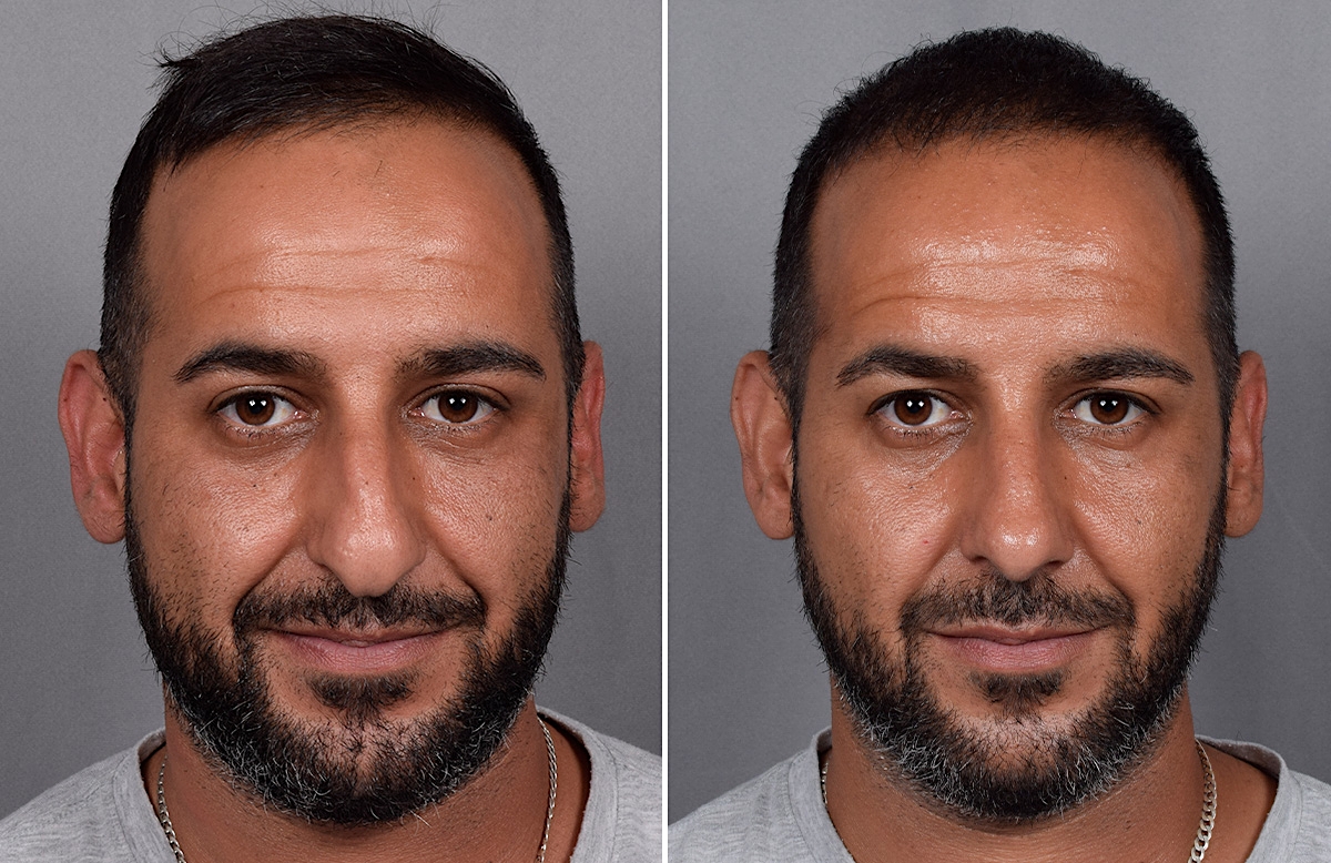 Rhinoplasty Before & After Gallery - Patient 253649 - Image 4