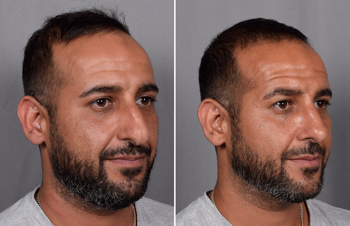 Rhinoplasty Before & After Gallery - Patient 253649 - Image 3