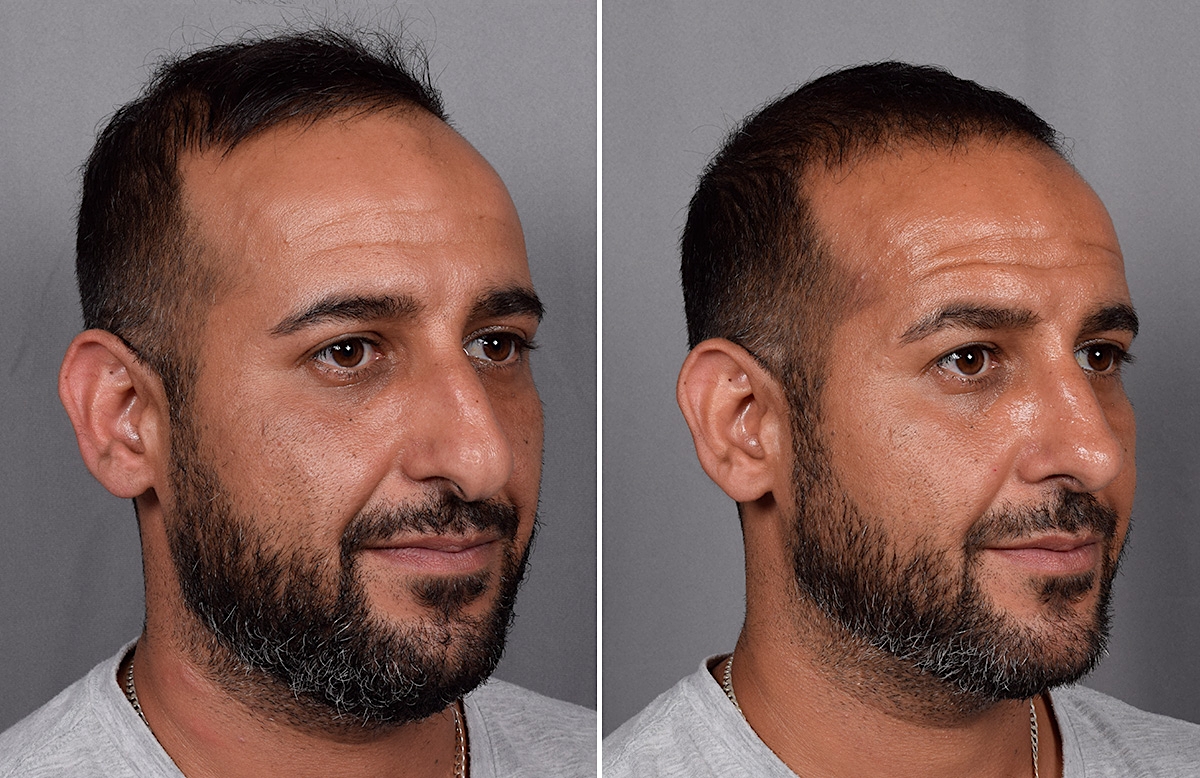 Rhinoplasty Before & After Gallery - Patient 253649 - Image 3