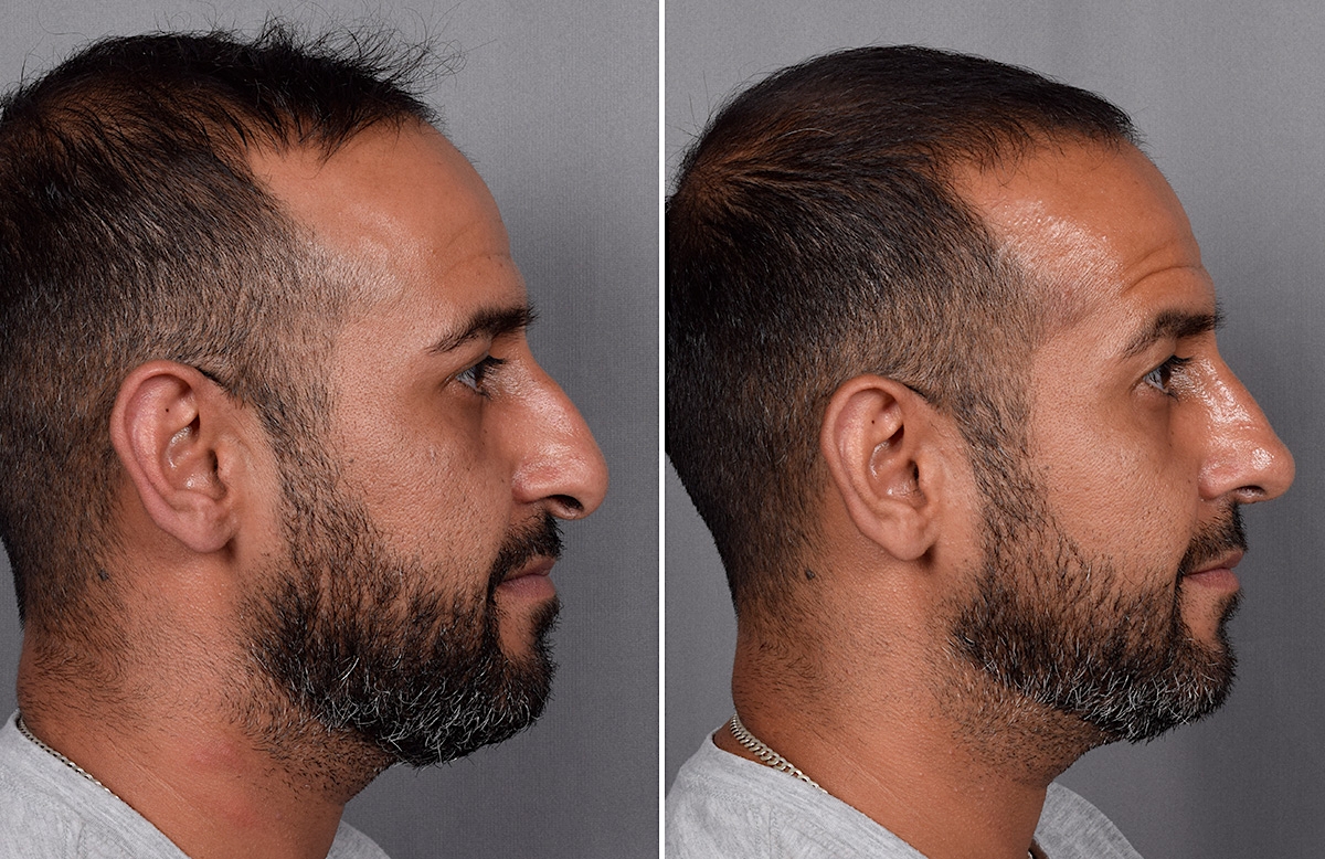 Rhinoplasty Before & After Gallery - Patient 253649 - Image 2