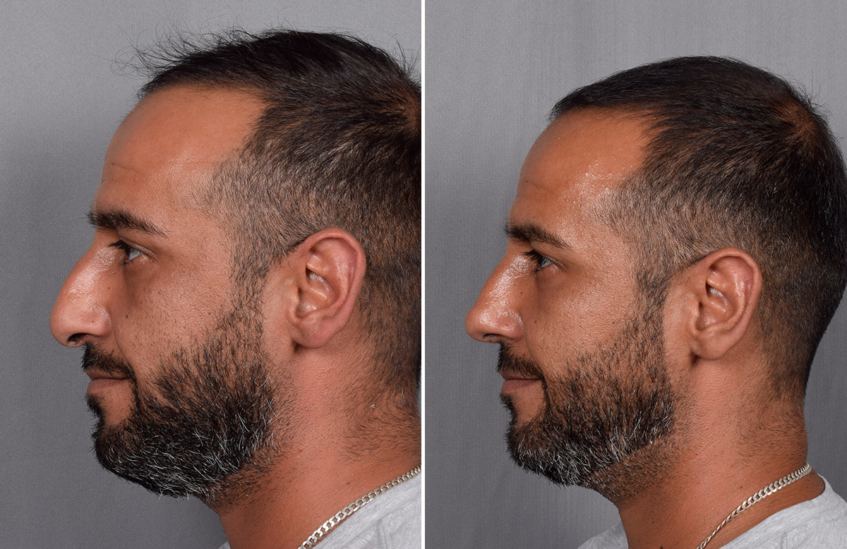 Rhinoplasty Before & After Gallery - Patient 253649 - Image 6