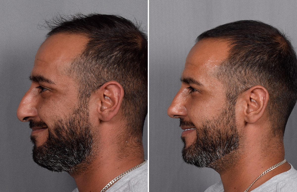 Rhinoplasty Before & After Gallery - Patient 253649 - Image 7