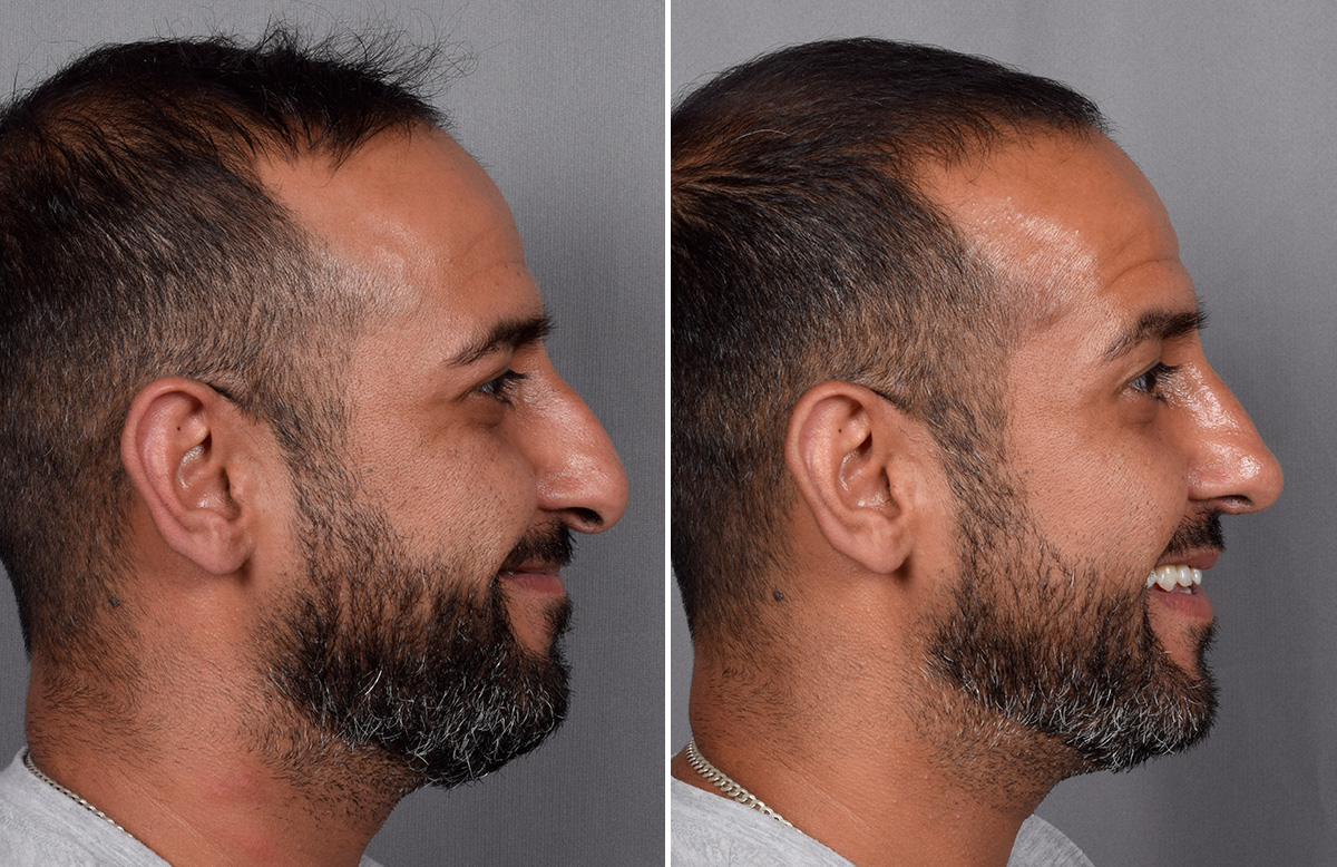 Rhinoplasty Before & After Gallery - Patient 253649 - Image 1