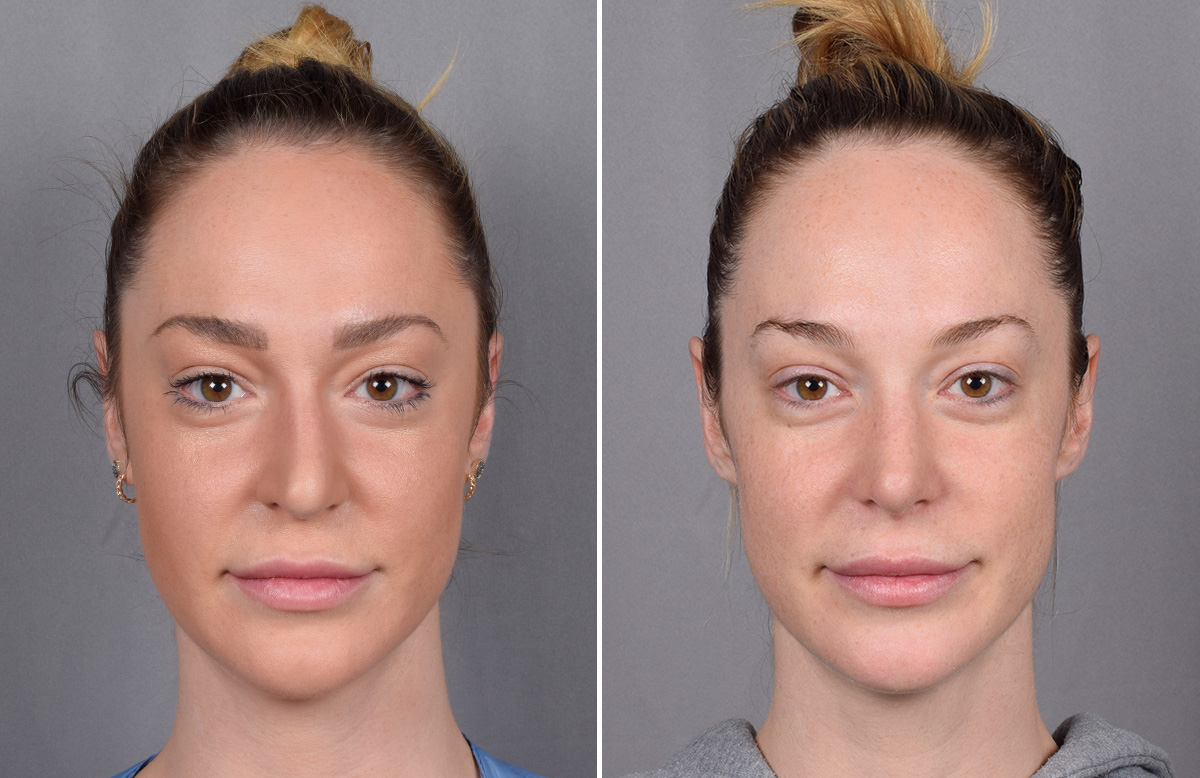Rhinoplasty Before & After Gallery - Patient 276318 - Image 4