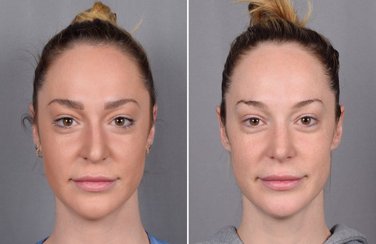 Rhinoplasty Before & After Gallery - Patient 276318 - Image 4