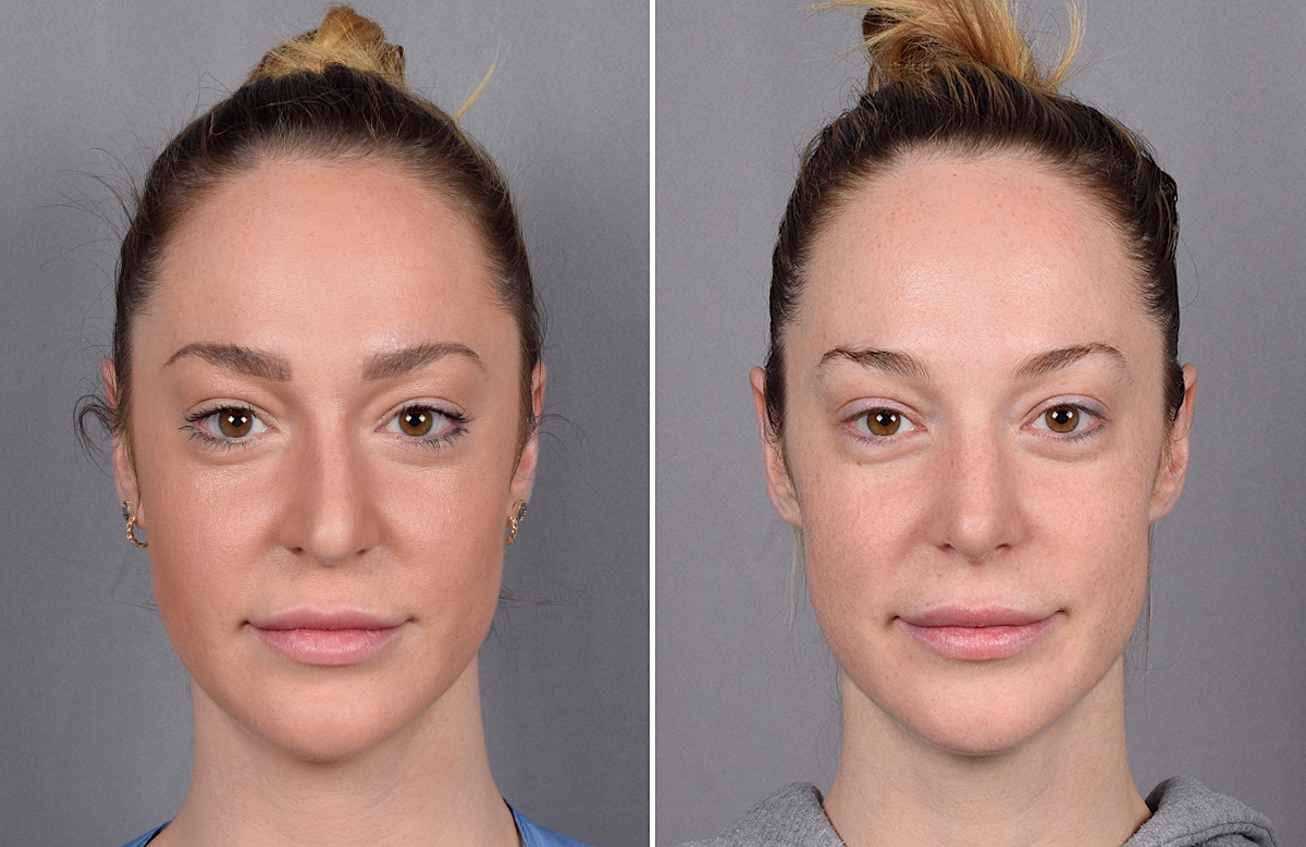 Rhinoplasty Before & After Gallery - Patient 276318 - Image 4