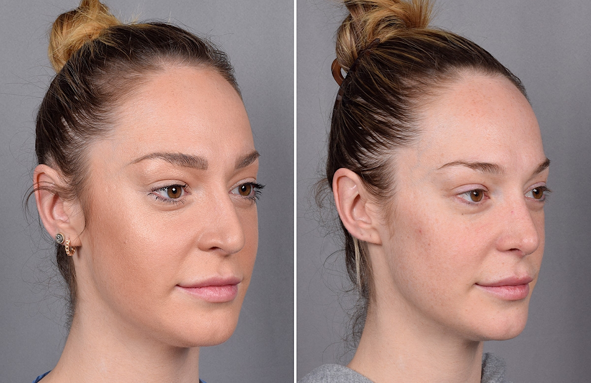 Rhinoplasty Before & After Gallery - Patient 276318 - Image 3