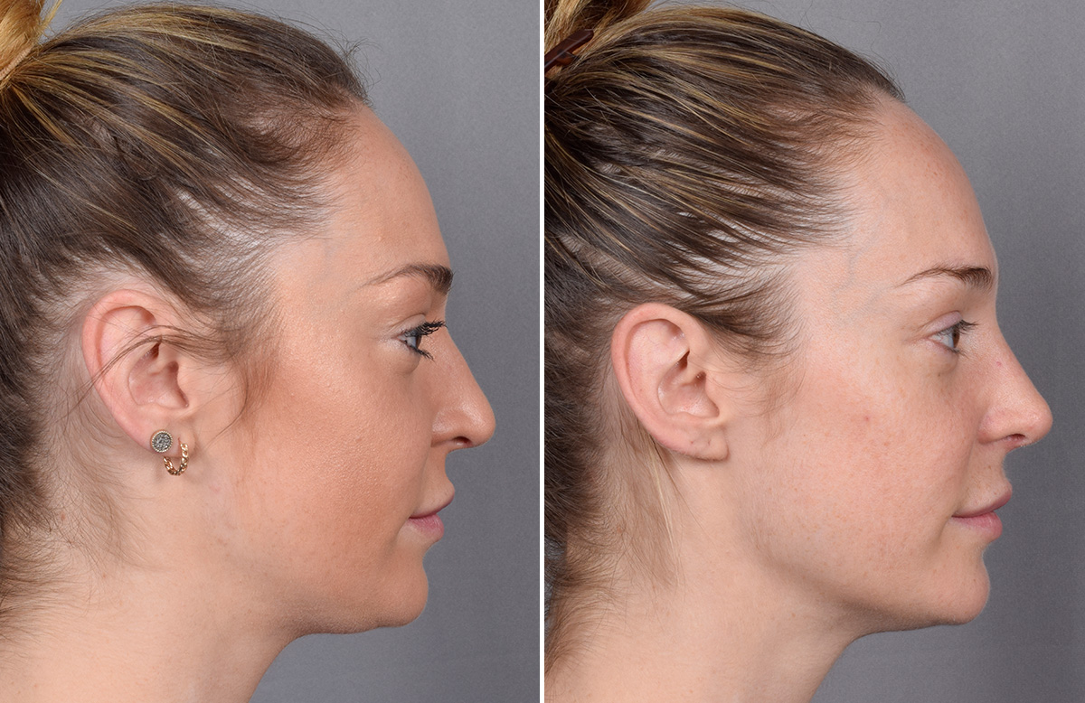 Rhinoplasty Before & After Gallery - Patient 276318 - Image 2