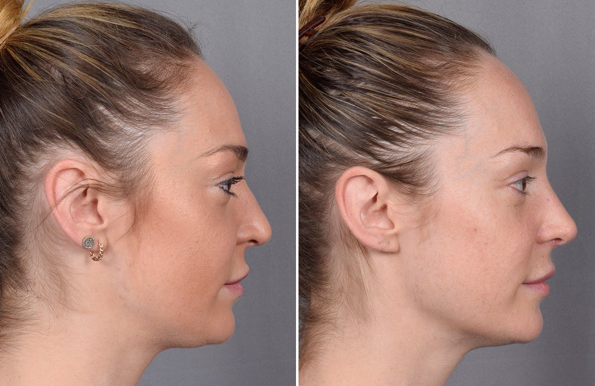 Rhinoplasty Before & After Gallery - Patient 276318 - Image 2